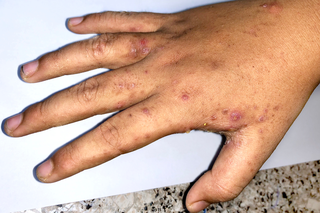 Dark spots caused by scabies on a hand with brown skin.