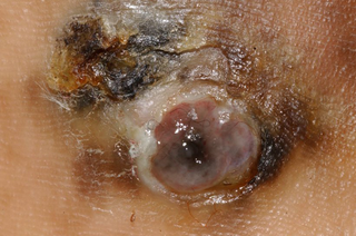 Close up of an acral lentiginous melanoma with broken skin and a sore