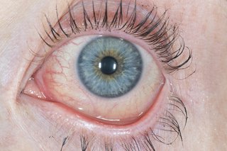 Allergic conjunctivitis