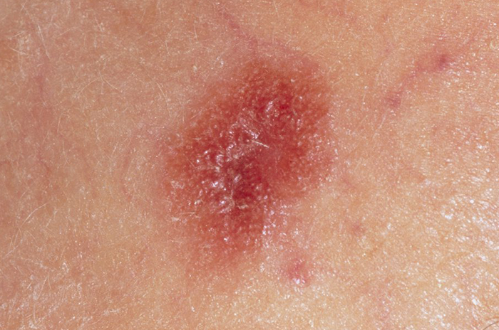 Skin Cancer melanoma HSE ie skin-cancer-melanoma-hse-ie