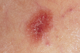 amelanotic melanoma on skin