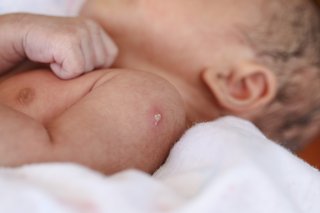 Injection site on upper arm oozes pus.