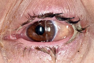 Conjunctivitis - HSE.ie