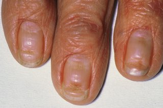 Three fingers with grooves in the finger nails