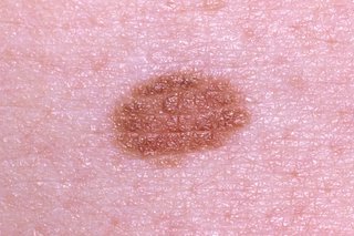 Light brown mole on white skin. The mole is oval-shaped with a smooth edge.