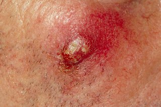 A pus-filled boil at the centre of red and inflammed area of skin.