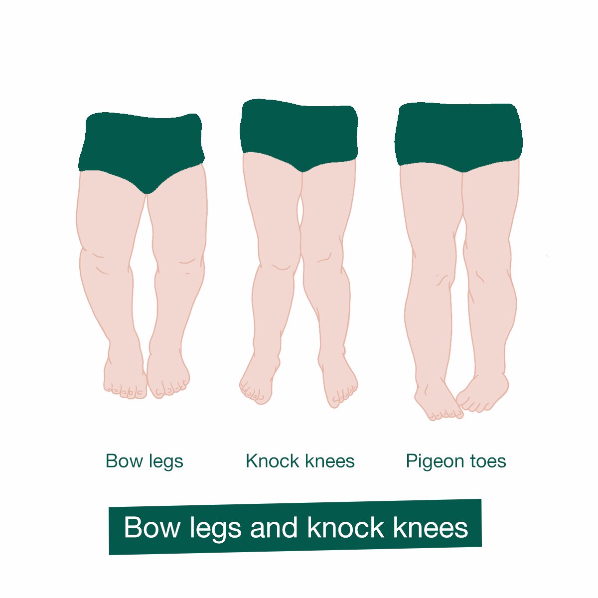 Bow Legs And Knock Knees In Children Hseie