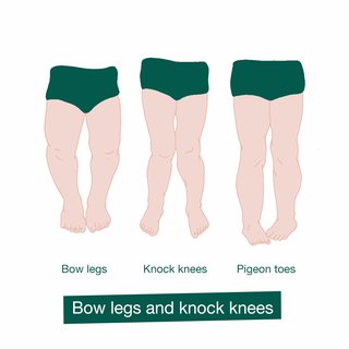 An illustration showing the differences between bow legs and knock knees