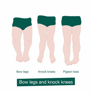 Bow legs and knock knees in children HSE.ie