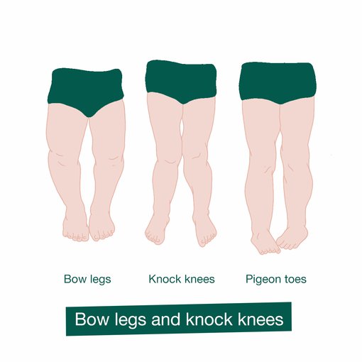 Bow legs and knock knees in children - HSE.ie