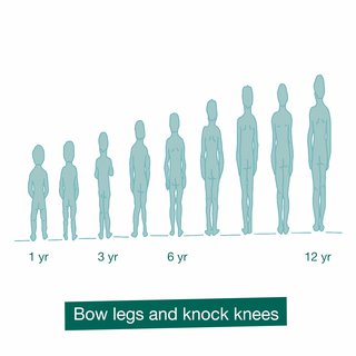Illustration showing how bow legs and knock knees improve over time