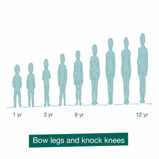 Bow legs and knock knees in children - HSE.ie