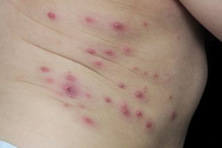 Small red bumps dotted around the tummy, shown on white skin.