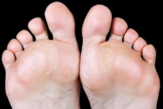 Calluses on feet