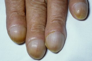 four fingers with fingernails that are curved over fingertips