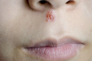 Close up of a face with a cold sore blister between the nose and mouth