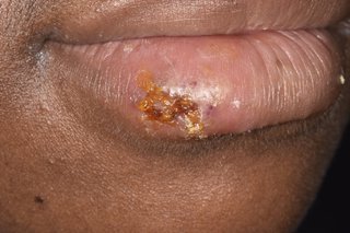 Close up of a mouth with a cold sore scab on the lower lip