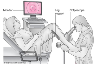 woman on medical chair with doctor performing colposcopy