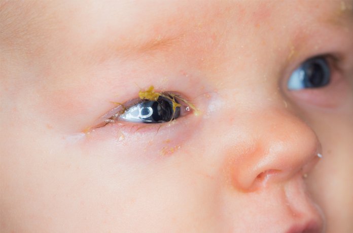 Conjunctivitis HSE ie