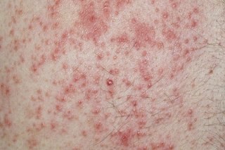 lots of small red dots on white skin