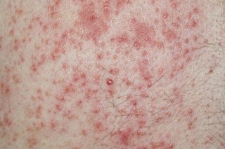 Pityriasis rosea - NHS