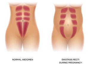 Two illustrated figures showing the six pack muscle. One figure shows a normal abdomen (tummy) and the other figure shows a diastasis recti through the middle of the tummy.