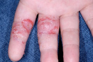 patches of cracked, red skin on two fingers of a white hand
