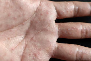 the palm and fingers of a white hand covered with small spots