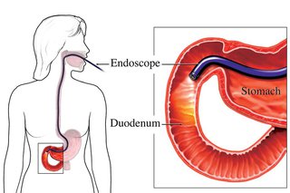 diagram shows a long thin tube going from a person's mouth through the stomach and into the duodenum. An inset diagram shows a close-up of the end of the tube in the duodenum with its light on