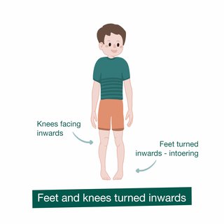 Illustration of in-toeing showing feet and knees turned inwards