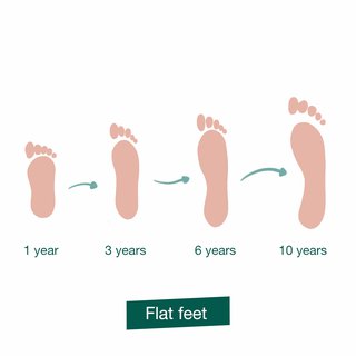 Illustration showing how children born with flat feet usually develop an arch at 6 to 10 years old