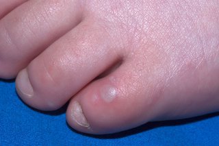 Blisters on a child's toe