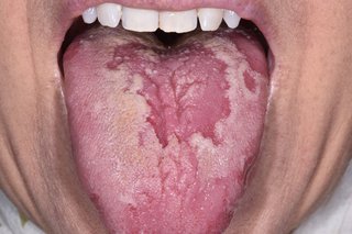 patches on tongue