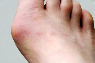 Right foot with lump at base of big toe and the skin looks hard and red