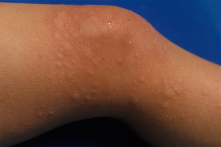 Image of hives on a leg