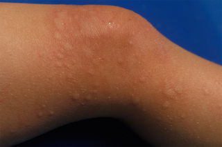 rashes in children with no fever