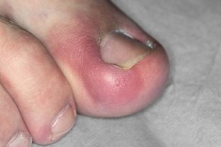 Ingrown nail on a big toe that is red and swollen, shown on white skin.