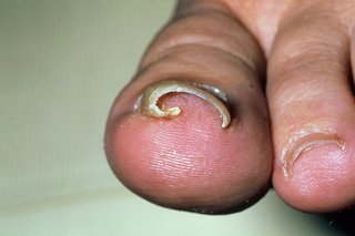 A curved ingrown toenail on big toe, shown on white skin.