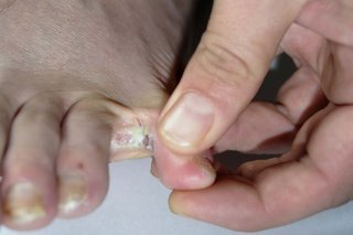 Athlete's foot on white skin. Toe is held back to show red, flaky patches that look sore.