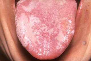 white patches on tongue