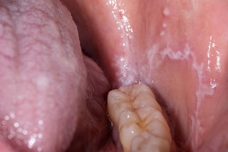 Picture of white patches inside mouth