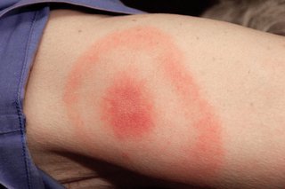 A round, red area, surrounded by a red, ring-shape rash, from Lyme disease. Shown on white skin.