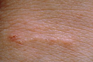 Tiny bumps in a line with a dot at one end, shown on white skin.