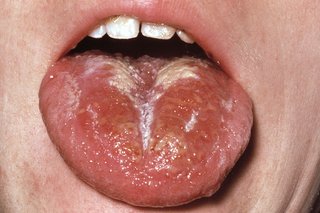 A white coating on a red, swollen tongue.