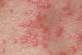 Red spots on white skin.