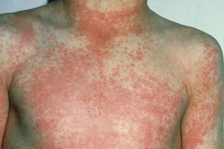 A pinkish rash on a child's chest and neck