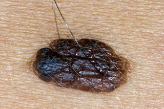Dark brown mole on white skin. The mole is raised and has a hair growing from it.