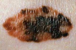 a mole on white skin that has more than 2 colours and has an uneven shape