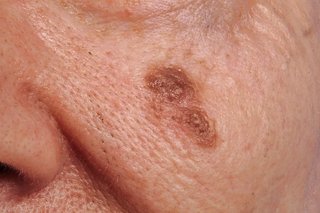 brown mole on a someone's cheek that is larger than 6mm wide