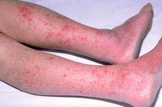 The rash usually starts as small, red pin-pricks. It spreads quickly and turns into red or purple blotches.